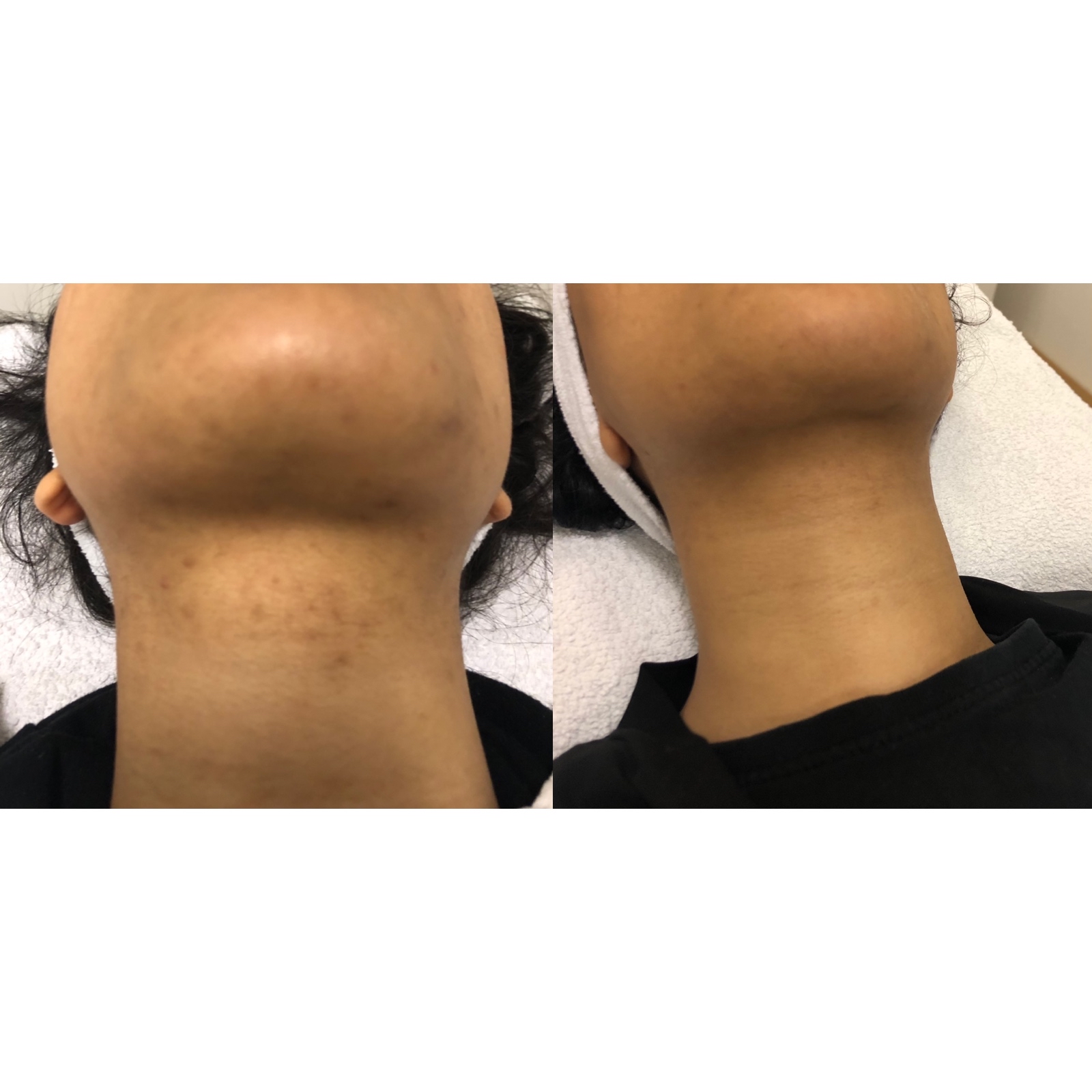 Acne Scarring & pigmentation