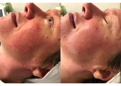 rosacea