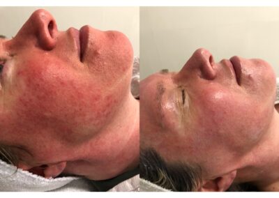 rosacea