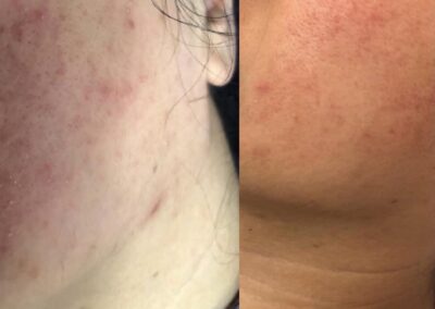 rosacea