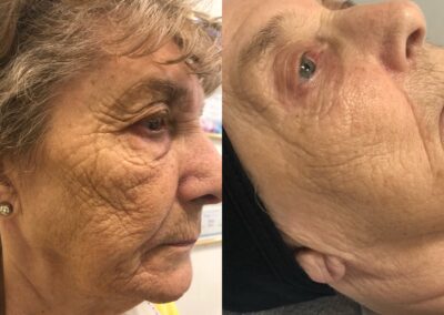 deep lines & wrinkles