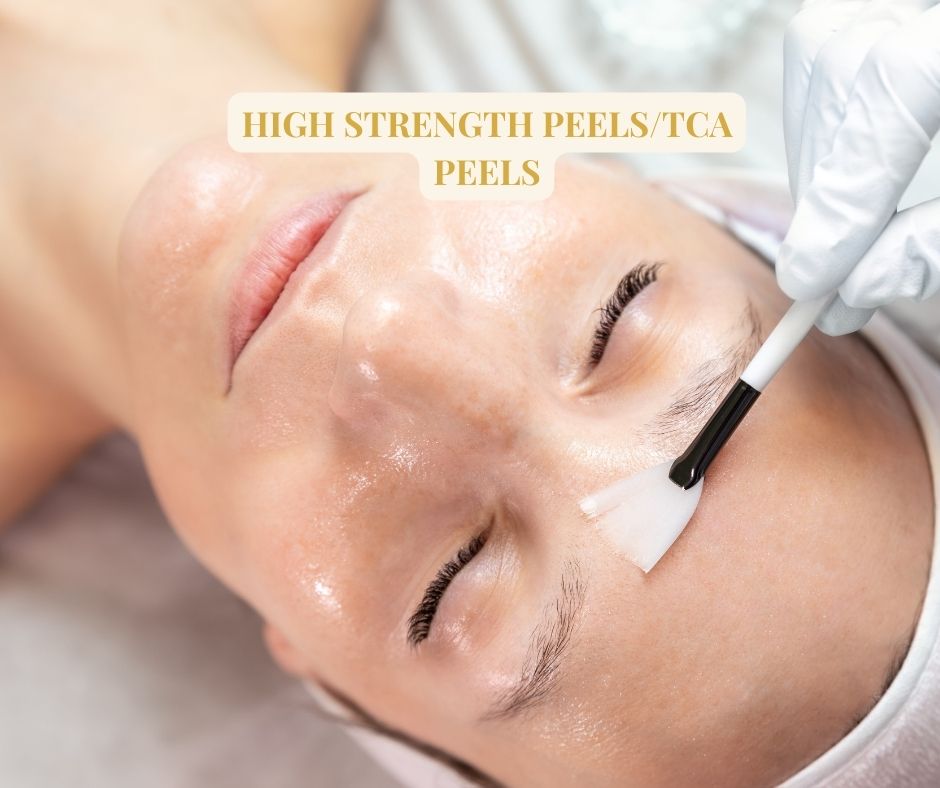 High Strength tca peels