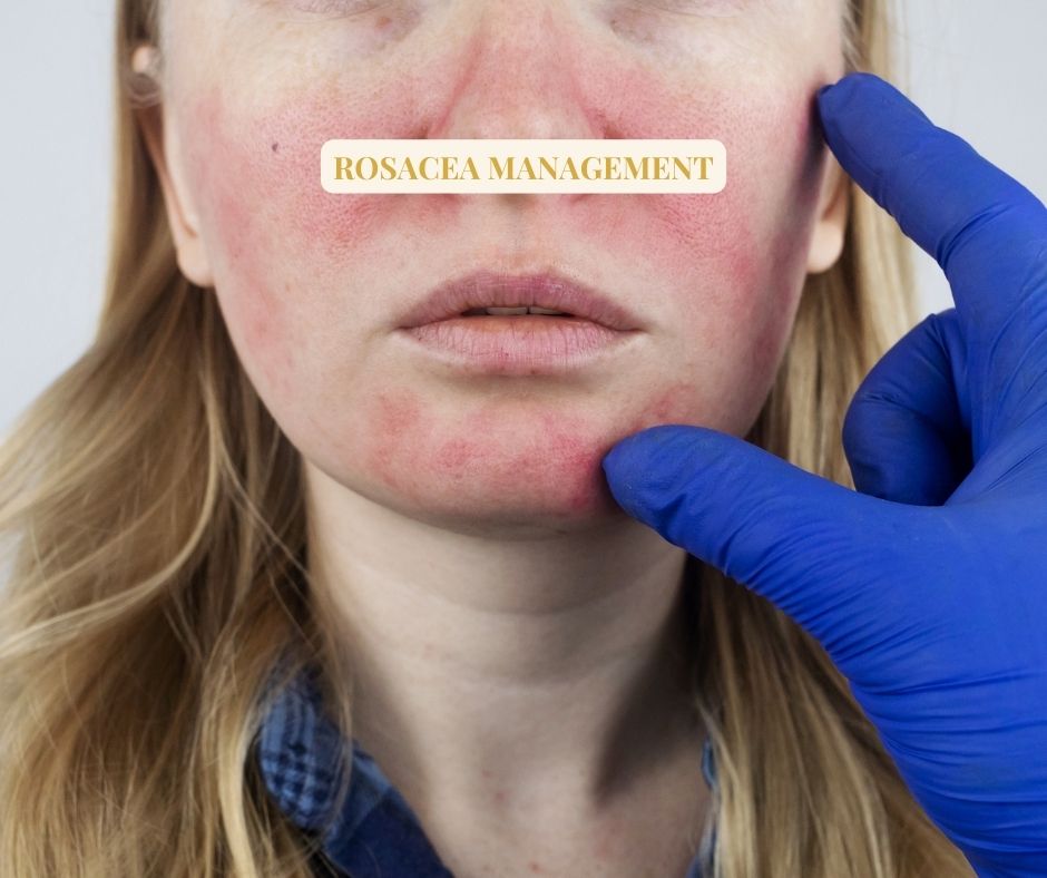 ROSACEA MANAGEMENT SOLUTIONS